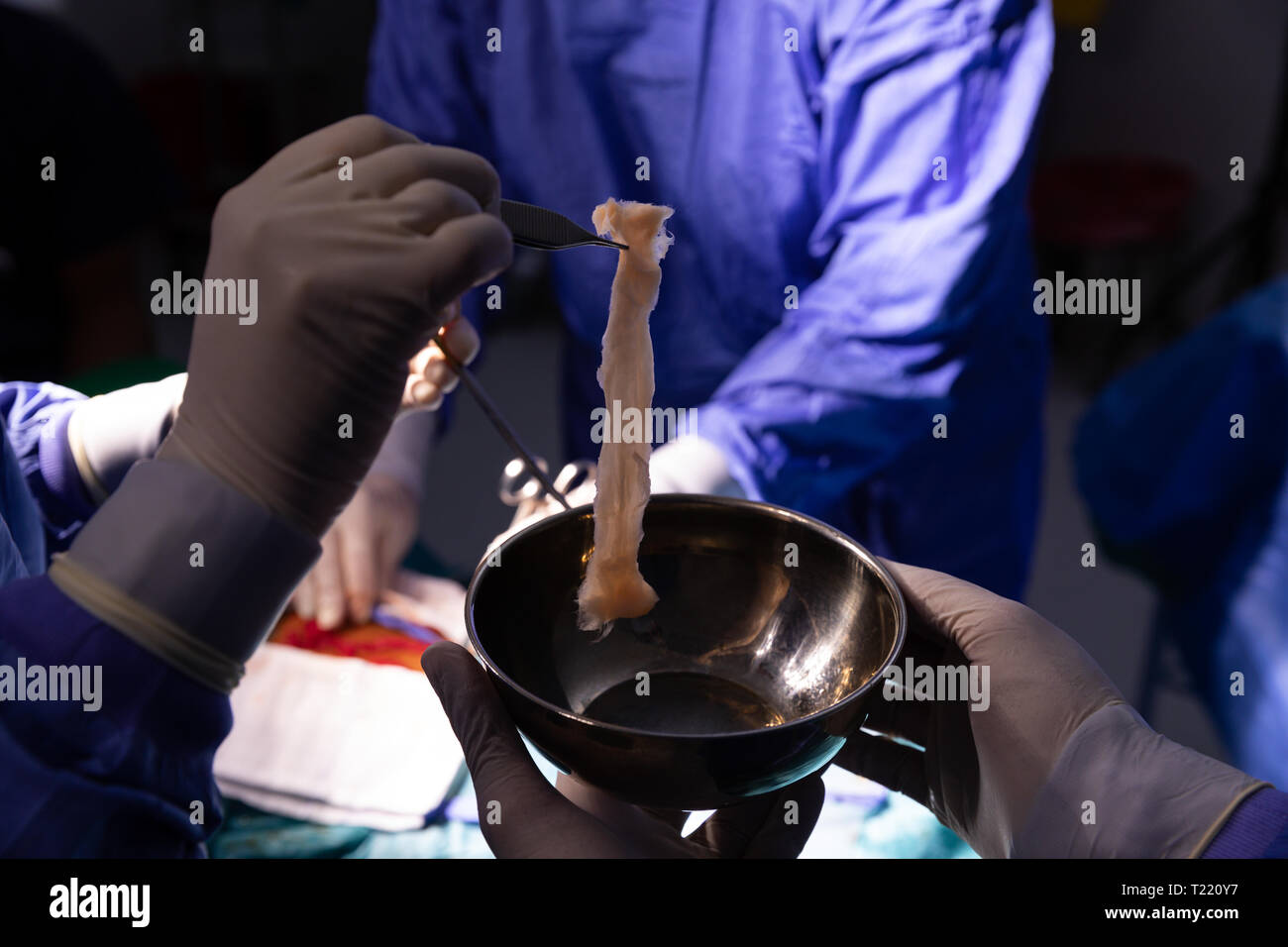 Surgeon hand putting a bit of human flesh in a bowl Stock Photo