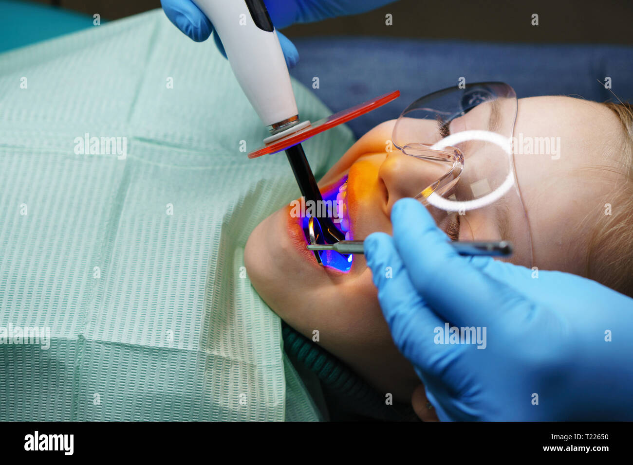 Dentist seals baby teeth to little girl. Treatment in dental clinic