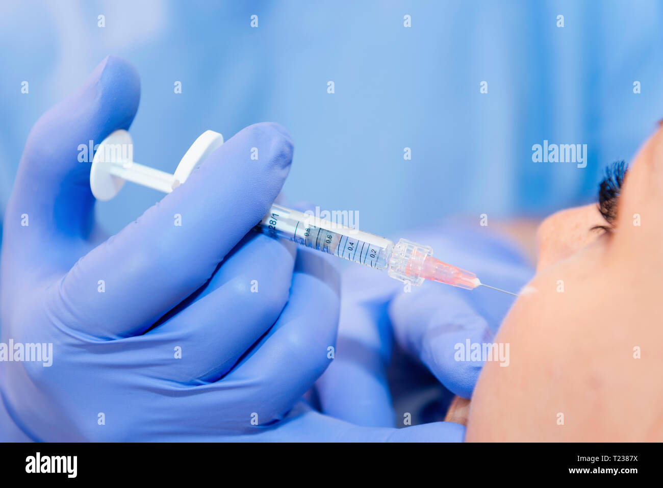 Hyaluronic acid beauty treatment performed on upper lip Stock Photo Alamy