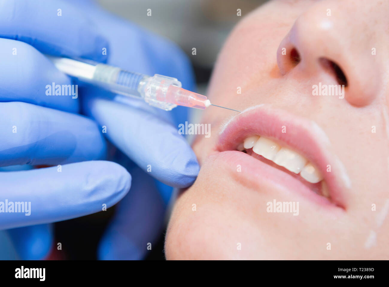 Beauty treatment with hyaluronic acid on upper lip, selective focus
