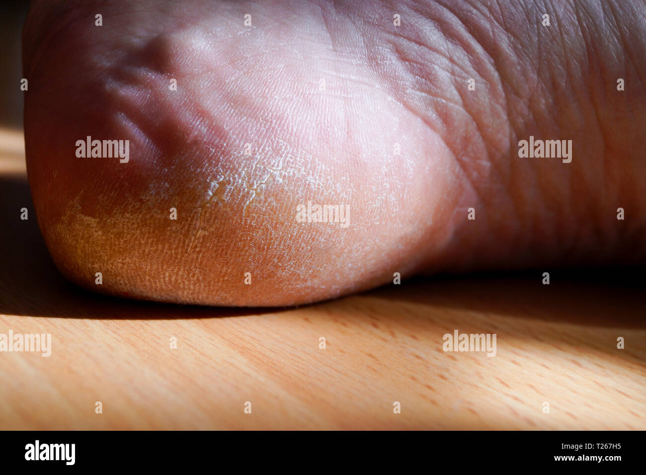 Closeup image of a heel on the foot with a white callus. Image for medical purposes. Stock Photo