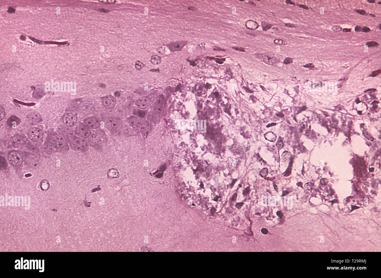 Hematoxylin-eosin stained photomicrograph of the cellular pathology associated with Tamiami virus encephalitis, 1972. Image courtesy Centers for Disease Control and Prevention (CDC) / Dr W. Winn. () Stock Photo