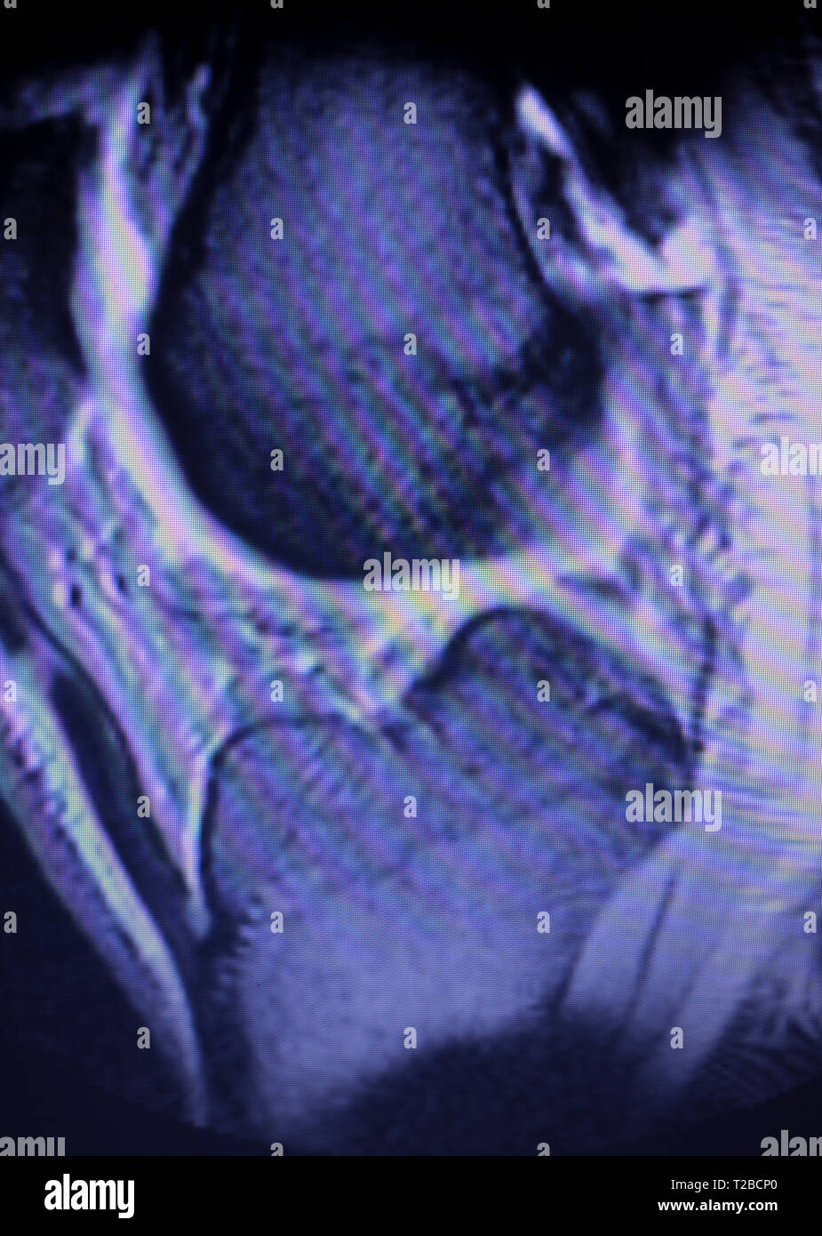 Magnetic resonance imaging MRI knee posterior horn medial meniscus tear ...