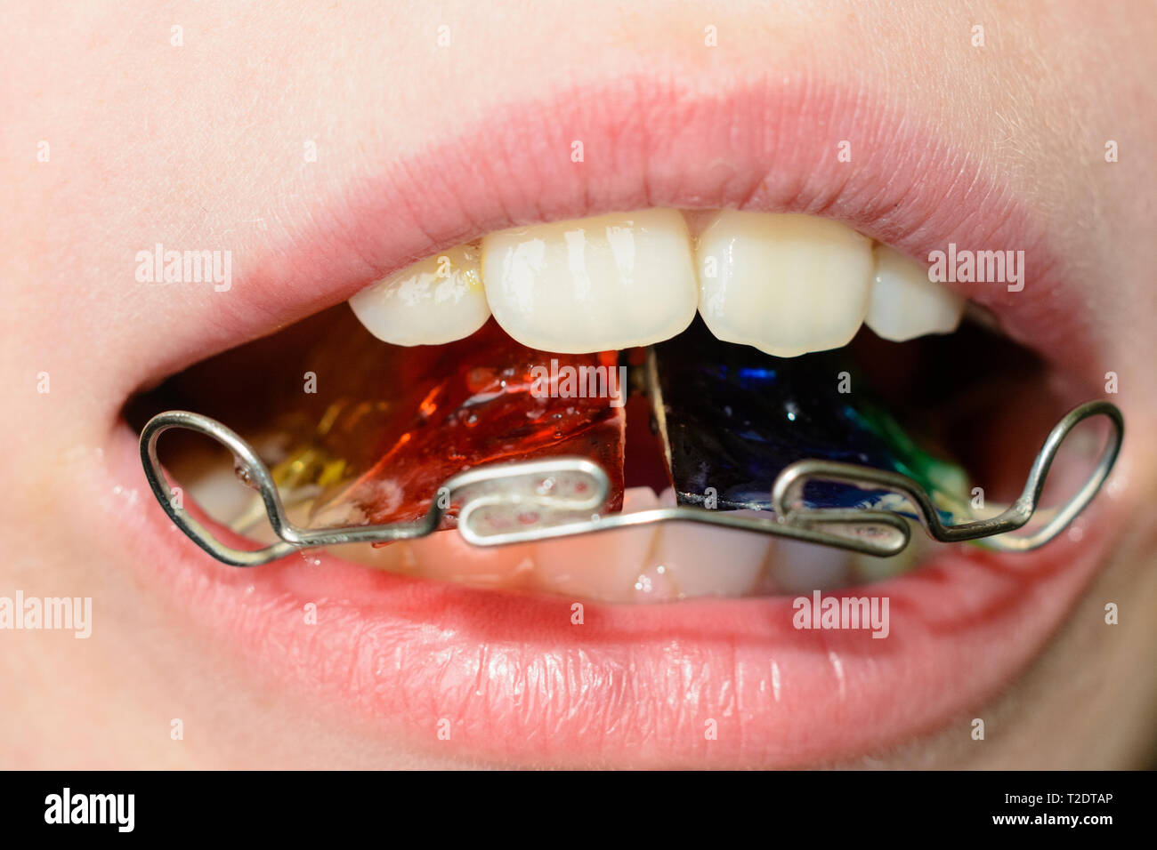 Closeup of a metal plate in the mouth on the teeth of a little boy