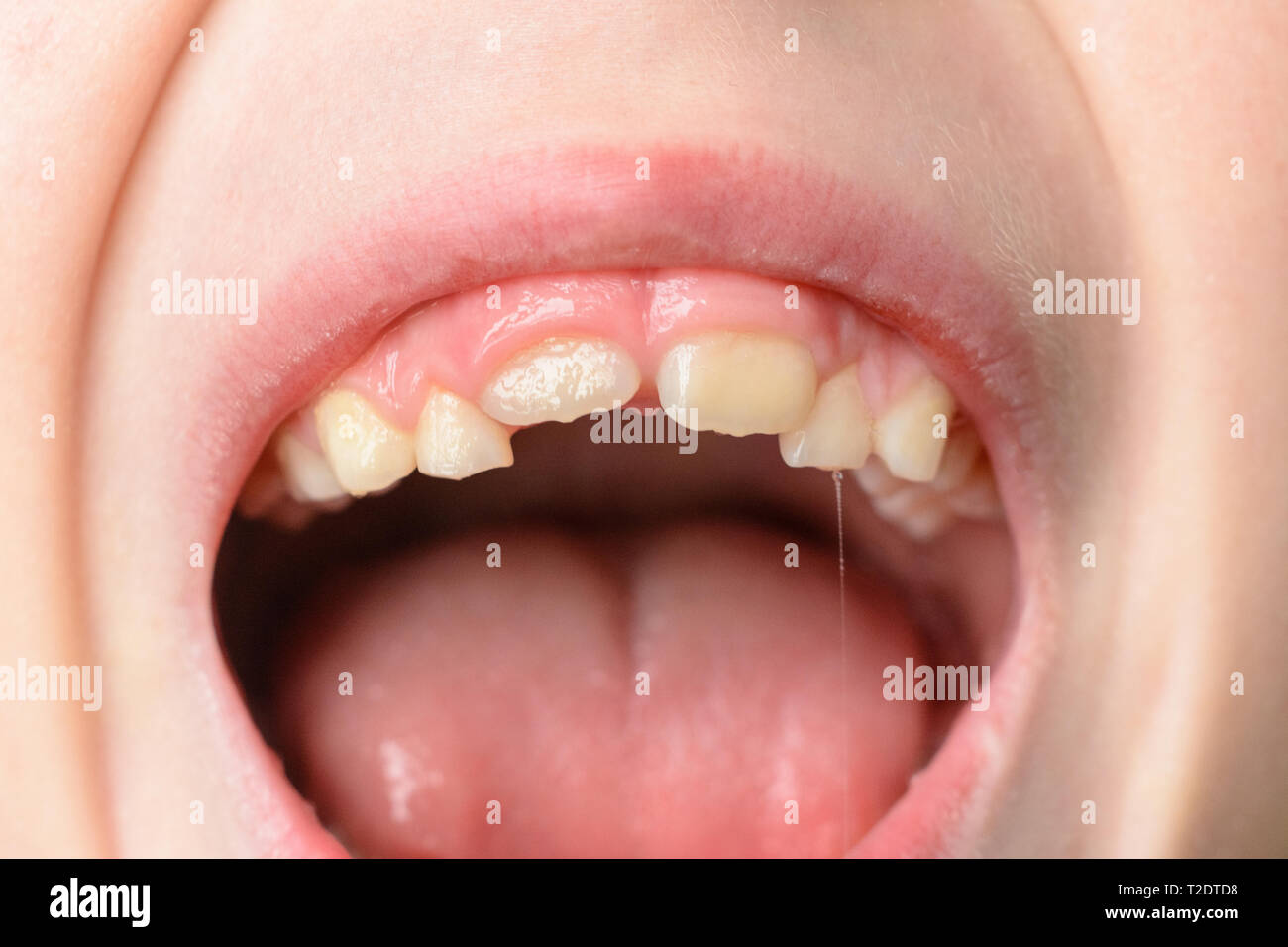 The child opens wide mouths, showing his crooked teeth after falling of ...