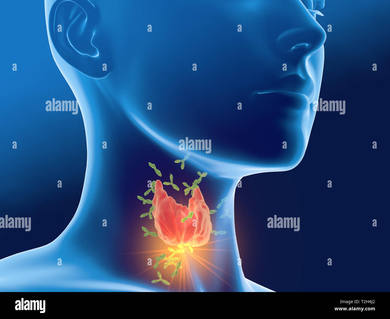 Medically 3D illustration showing antibodies attacking thyroid gland of