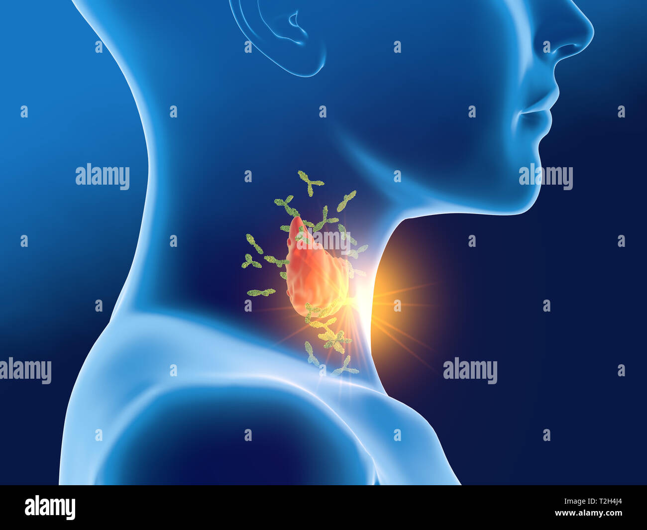 Medically 3D illustration showing antibodies attacking thyroid gland of