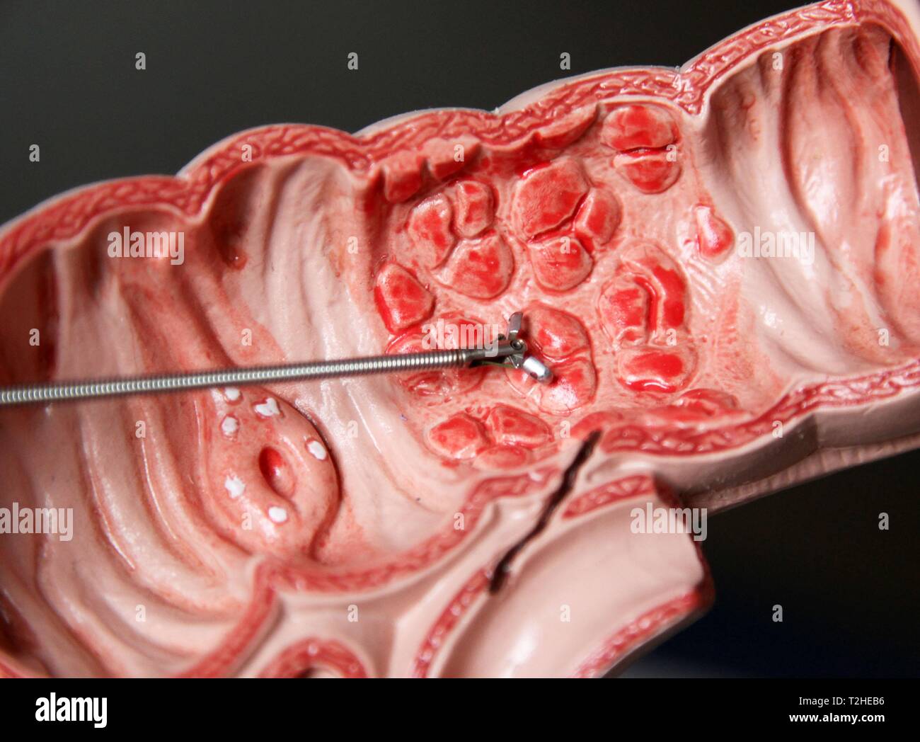 Removal Of Growths In The Human Intestine On Medical Model Hi res Stock 