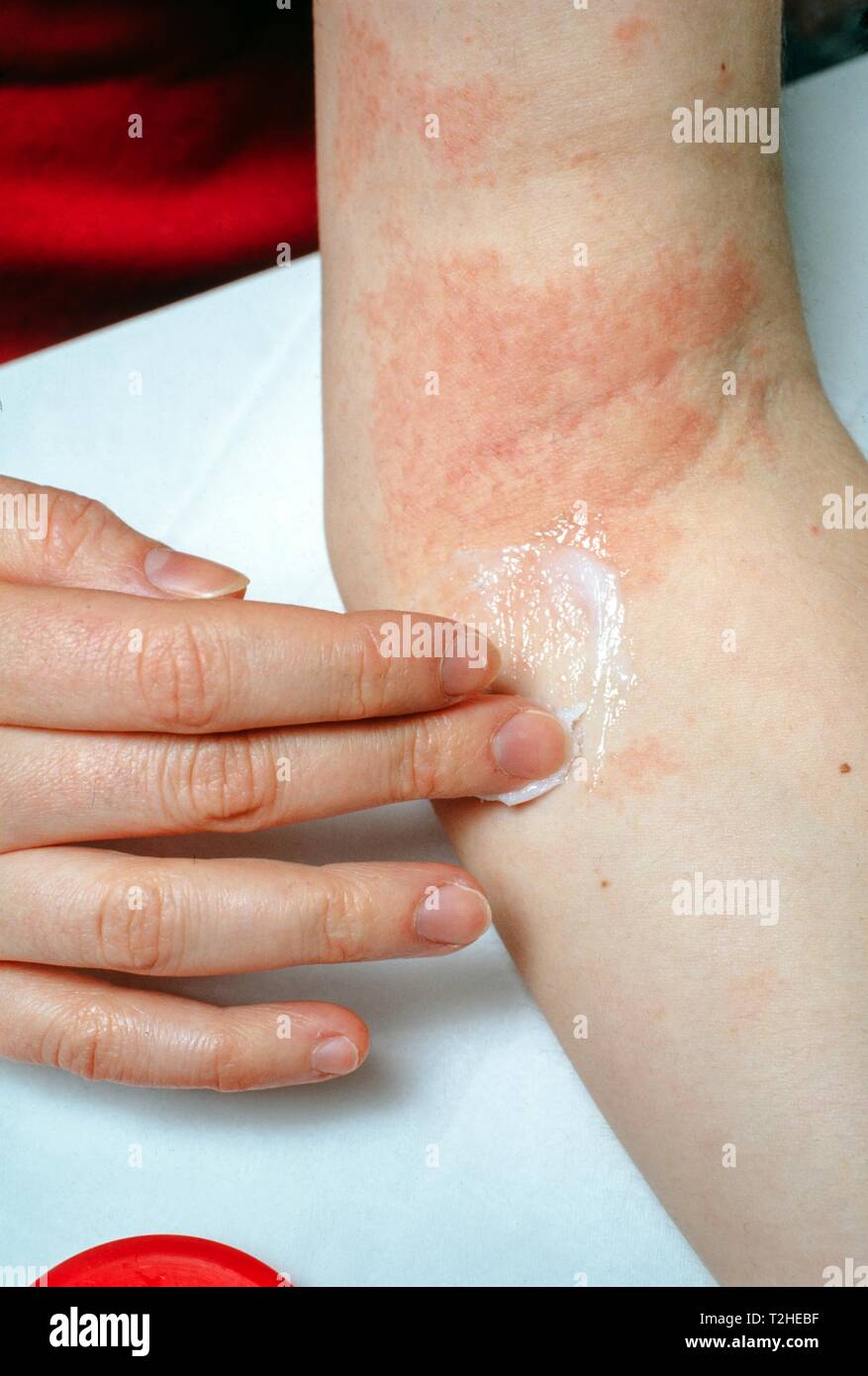 Woman applying ointment to eczema at the elbow, Germany Stock Photo