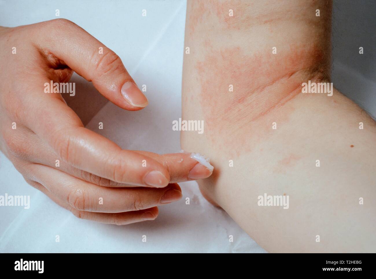 Woman applying ointment to eczema at the elbow, Germany Stock Photo