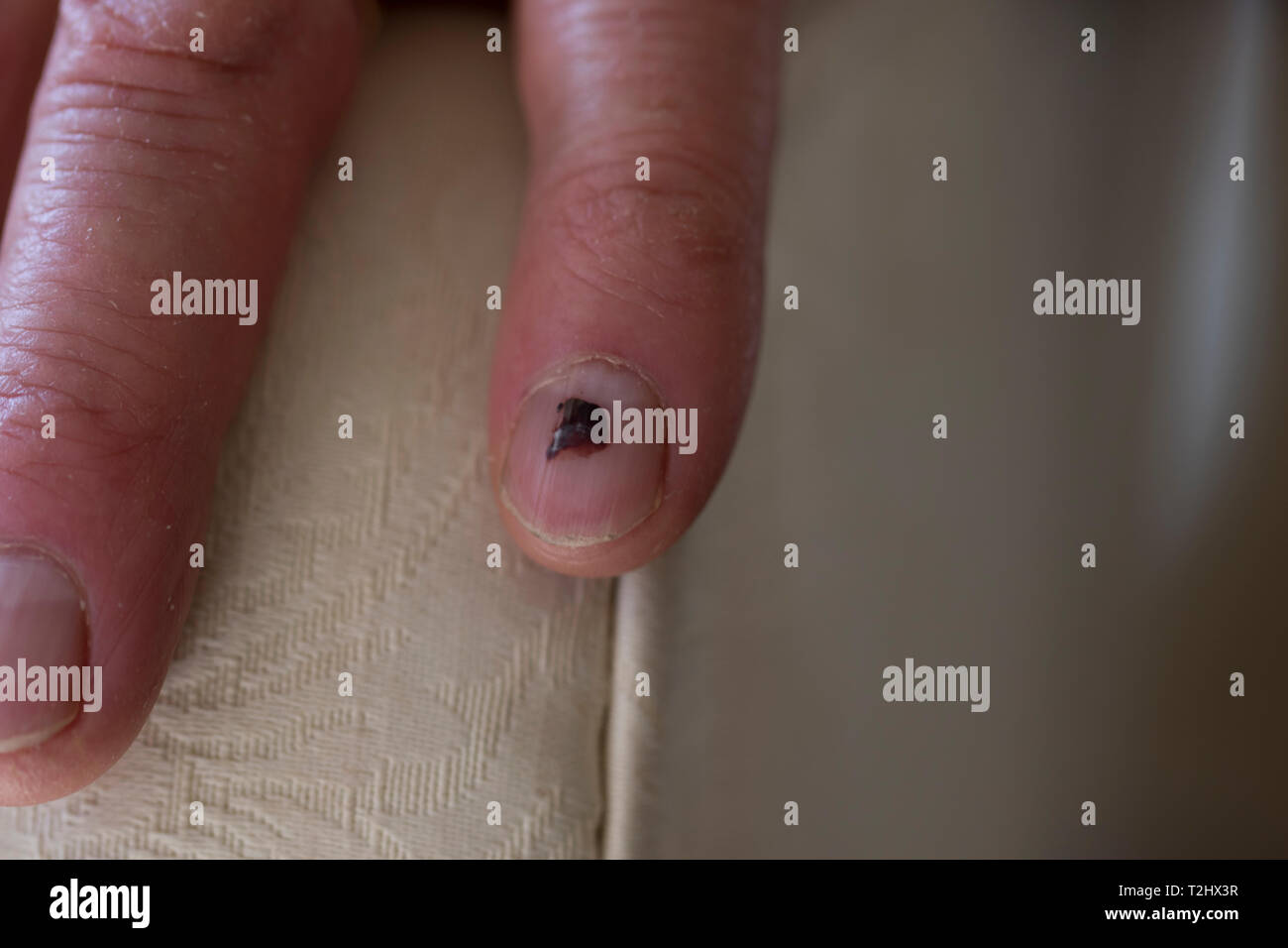 Damaged Nail Matrix Treatment