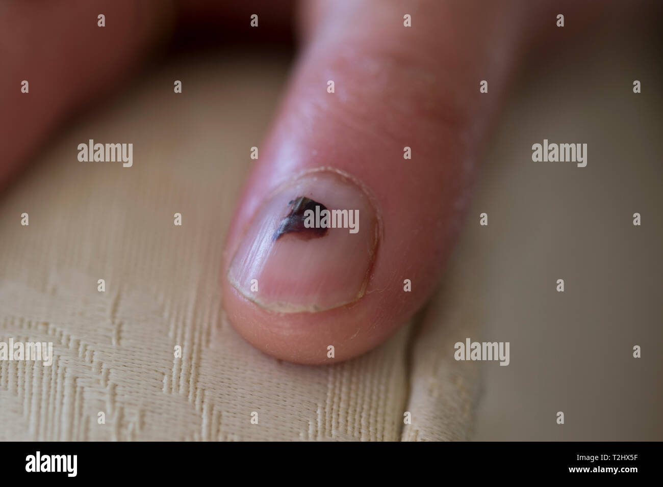 Blood Blister On Finger Nail Cuticle