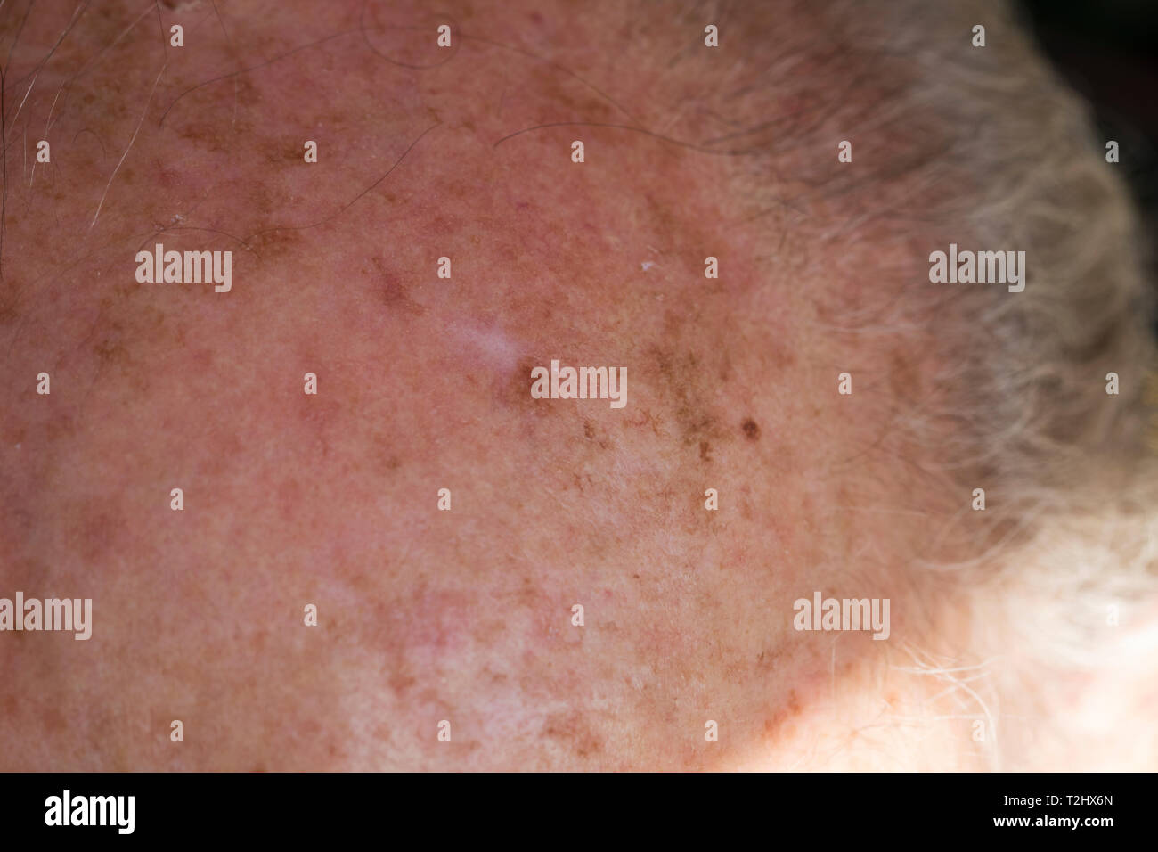Close up of elderly mans forehead with precancerous scaly skin caouse by sun damage. Sun tanning trauma on skin. Stock Photo