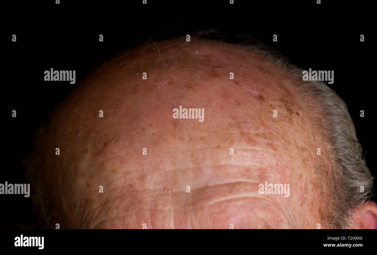 Patches of discolored skin on the forehead of an older man precancerous sun damage close up. Stock Photo