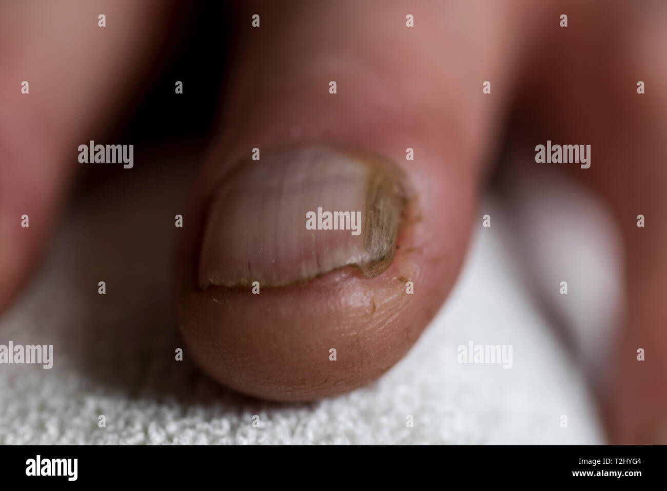 Fingernail damage grown out thicker yellow nail matrix trauma. Close up