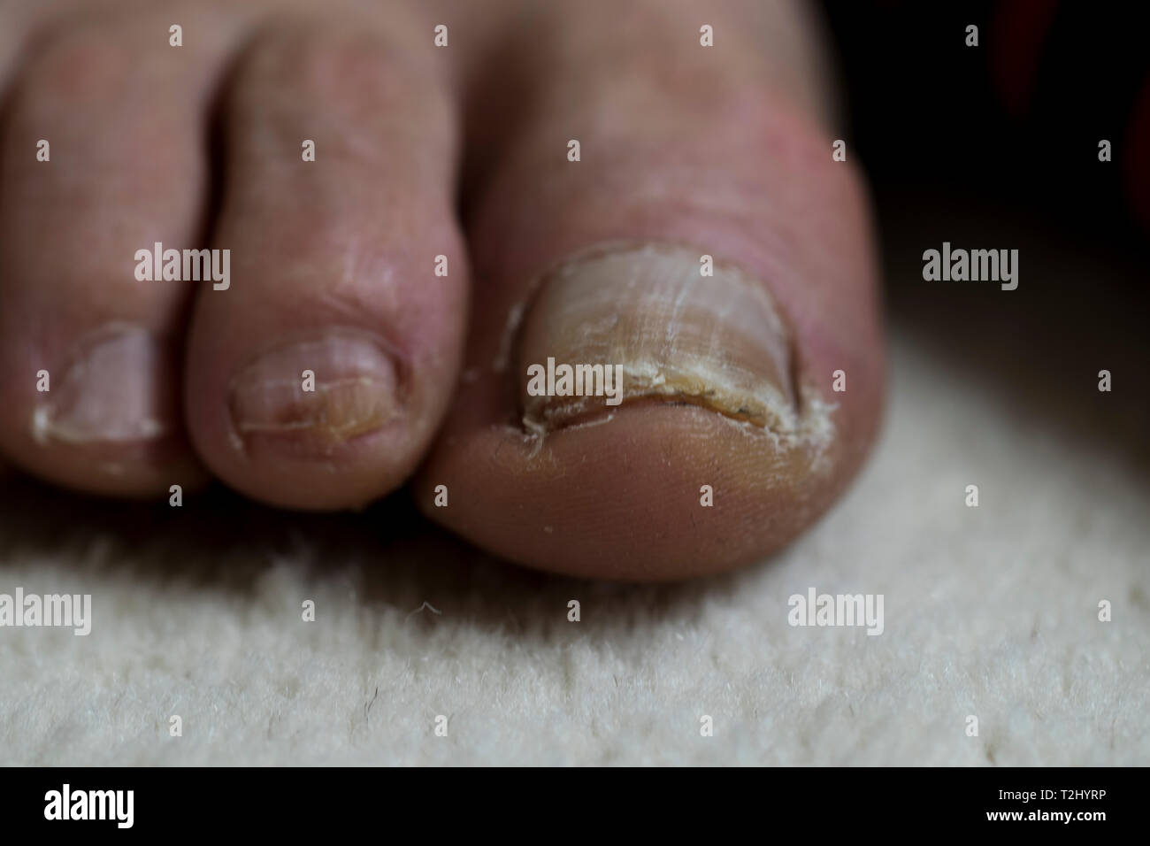 Big toe with nail damage. Elderly mans feet close up with nail trauma. Feet close up medical care concept. Stock Photo