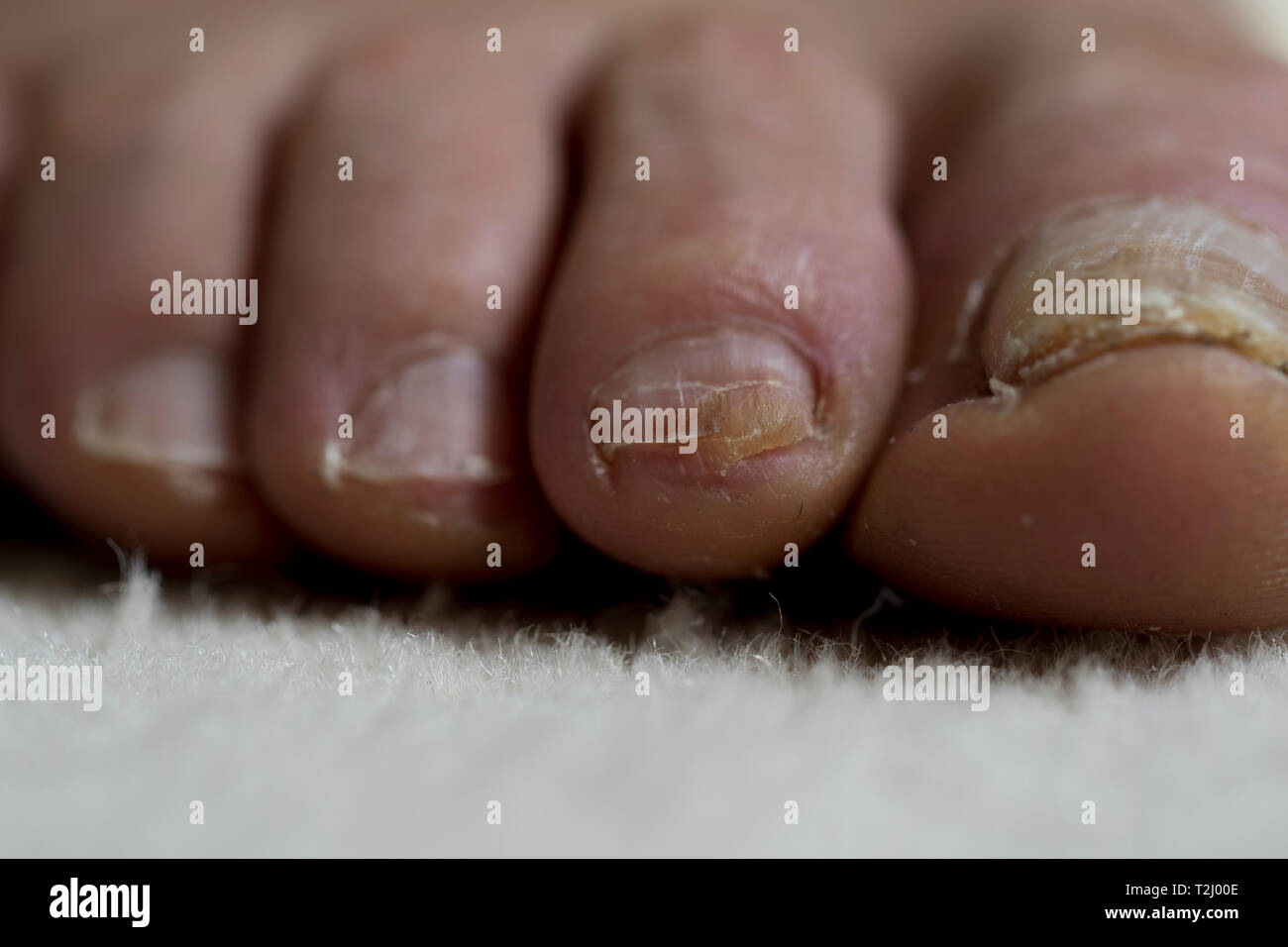 Toenail damage close up. Feet of an old man with toenail trauma and bacterial infection. Stock Photo