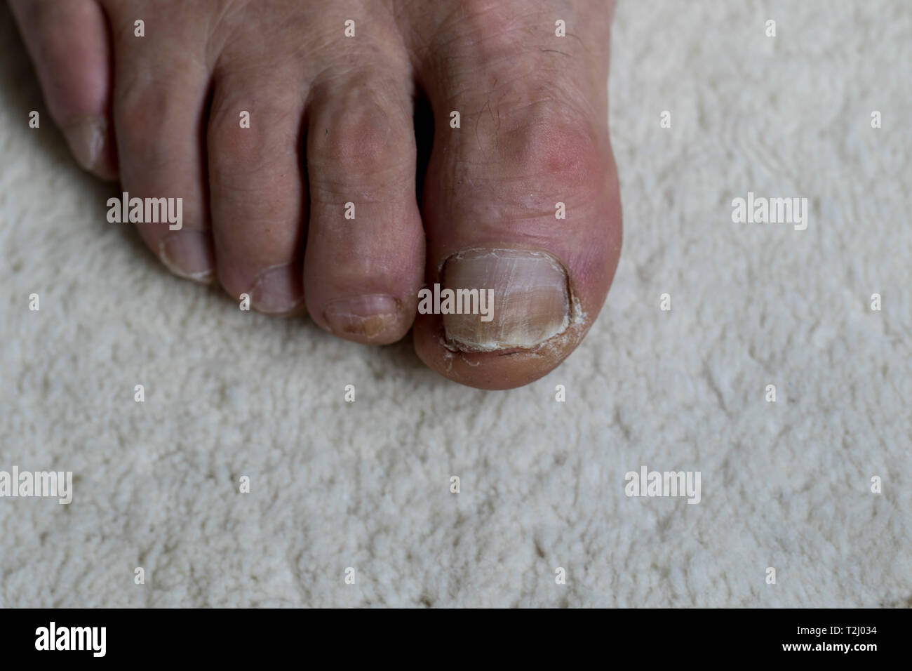Close up of old feet with damaged and neglected toenails. Fungal and bacterial nail trauma close up. Stock Photo