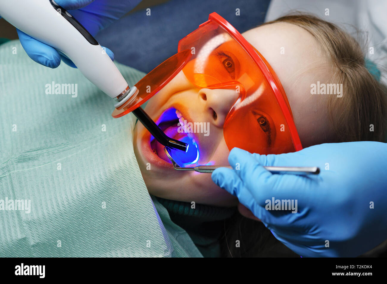 Modern caries treatment in children's dentistry. Dentist puts photo of