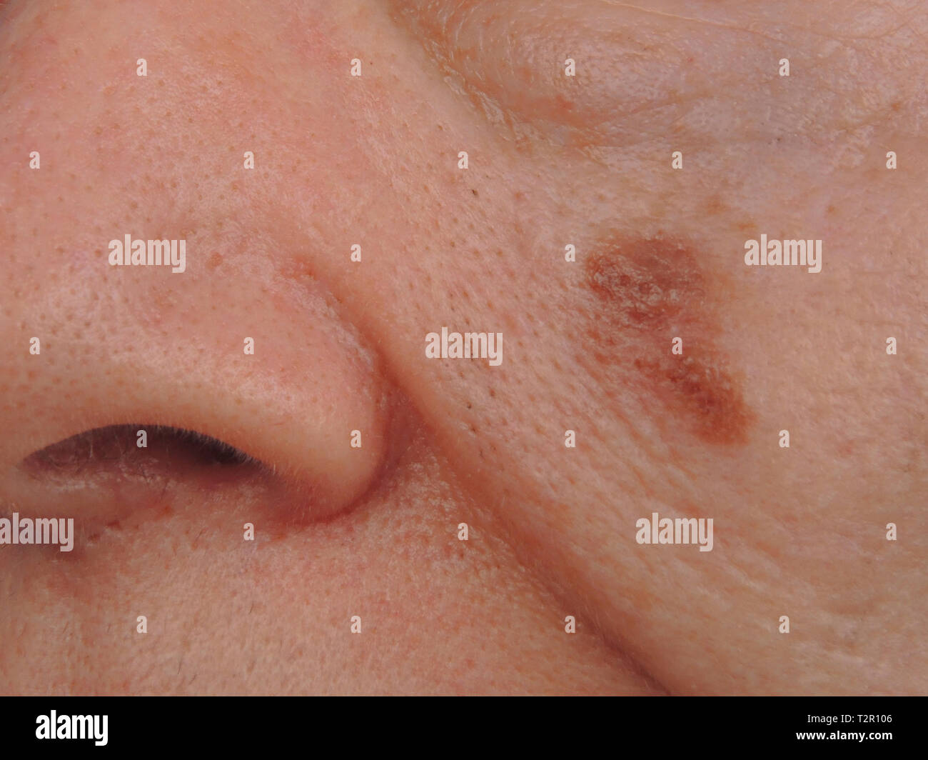 Melanoma Stock Photo - Alamy