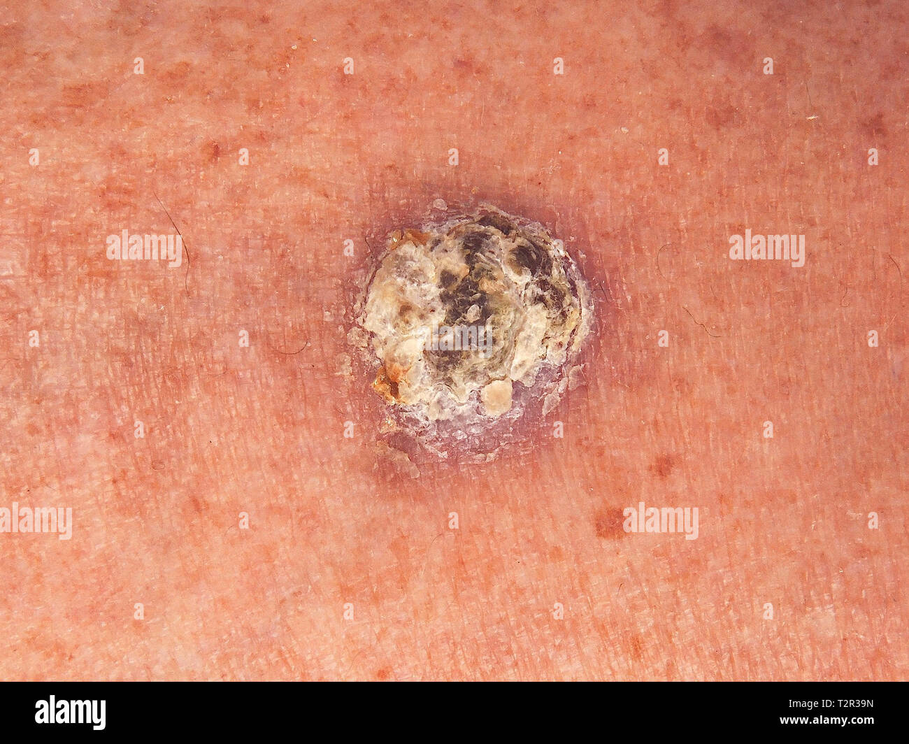 Hyperpigmented Nodular Basal Cell Carcinoma Download vrogue.co