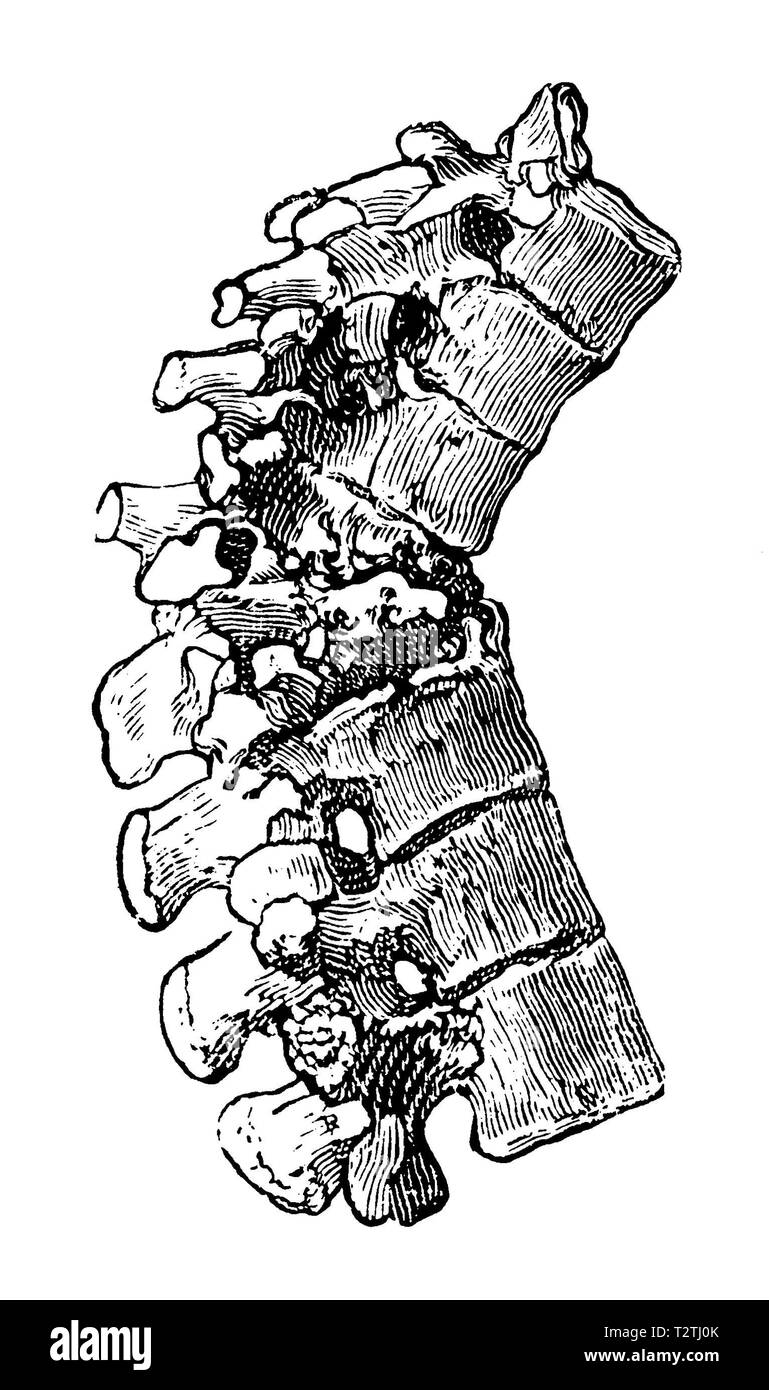 Tuberculosis of the spine,   1905 Stock Photo
