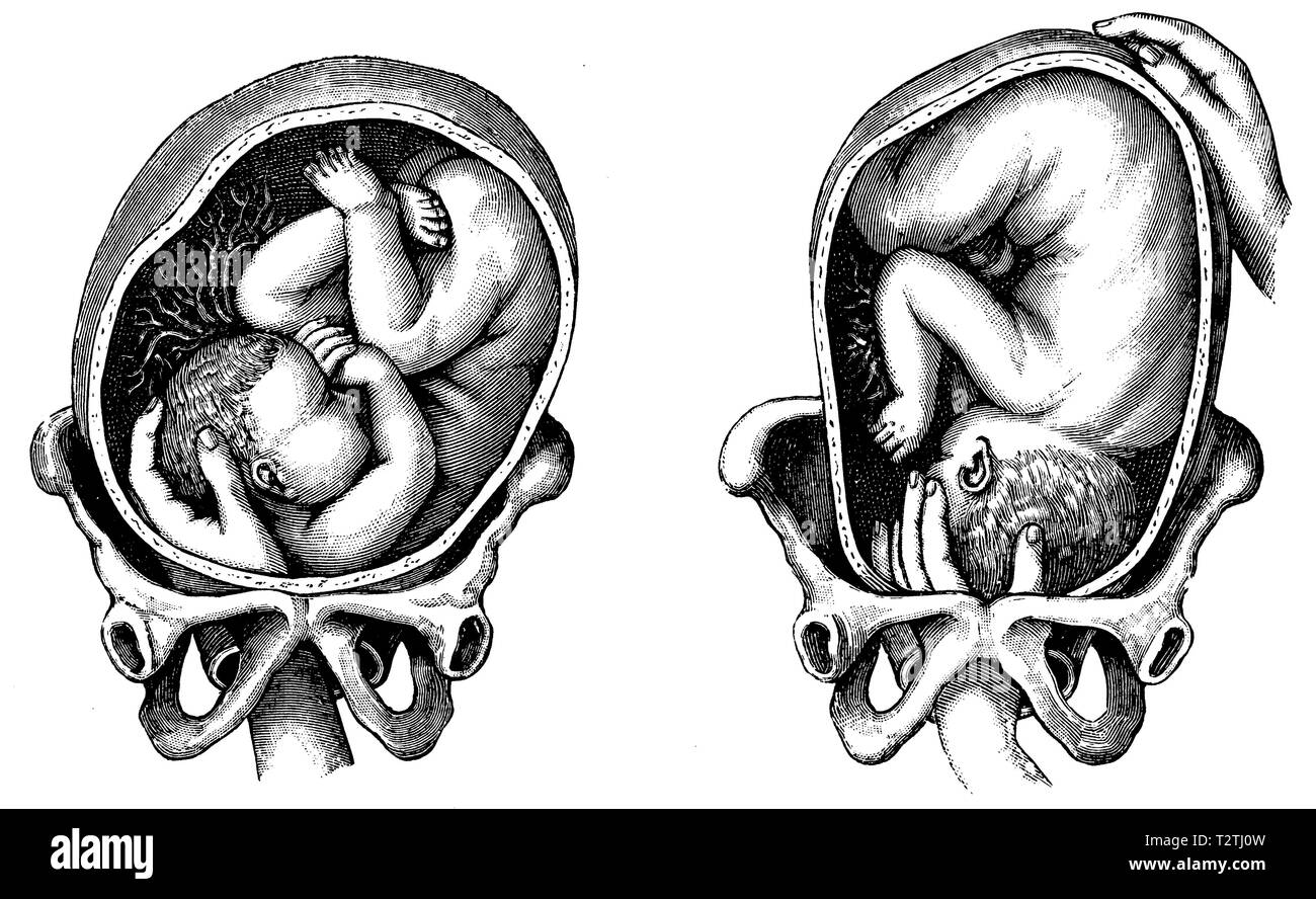 Turn the child upside down in the womb,   1905 Stock Photo