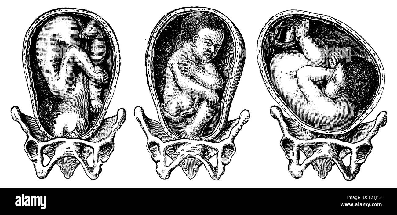 Breech Position High Resolution Stock Photography And Images Alamy
