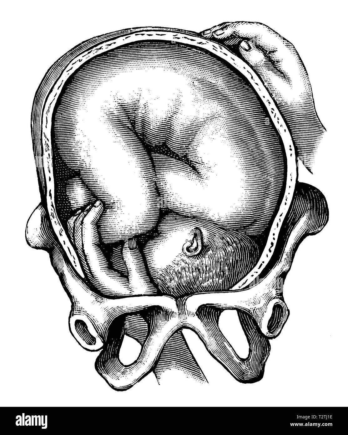 Turn of the child on the feet in the womb,   1905 Stock Photo