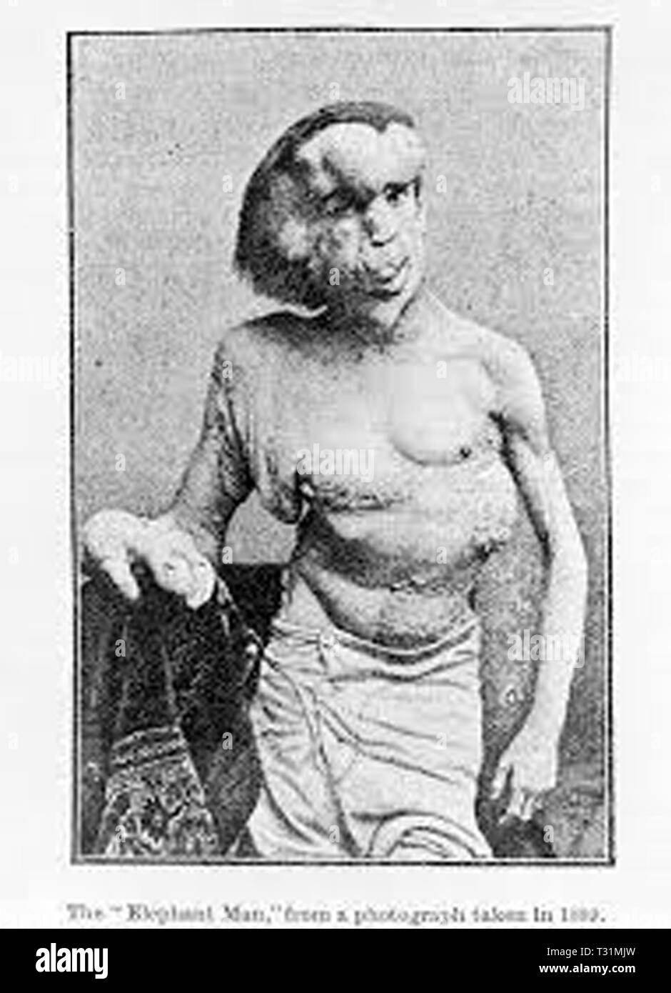 Proteus syndrome hires stock photography and images Alamy