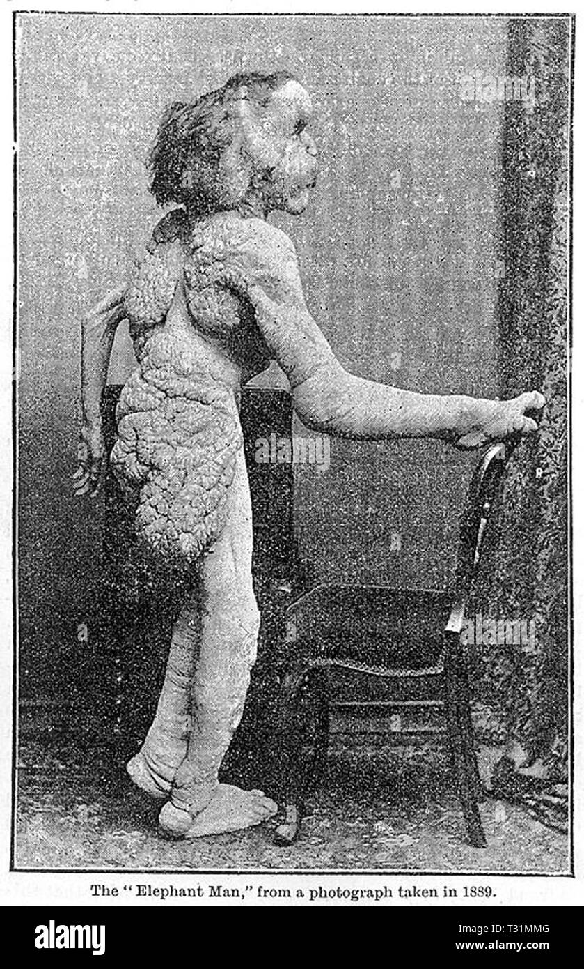 Joseph Merrick High Resolution Stock Photography and Images Alamy