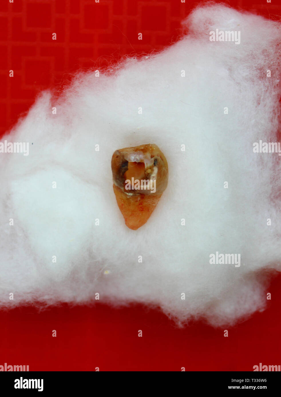 Wisdom tooth with cavity extracted from the mouth of an adult human female Stock Photo