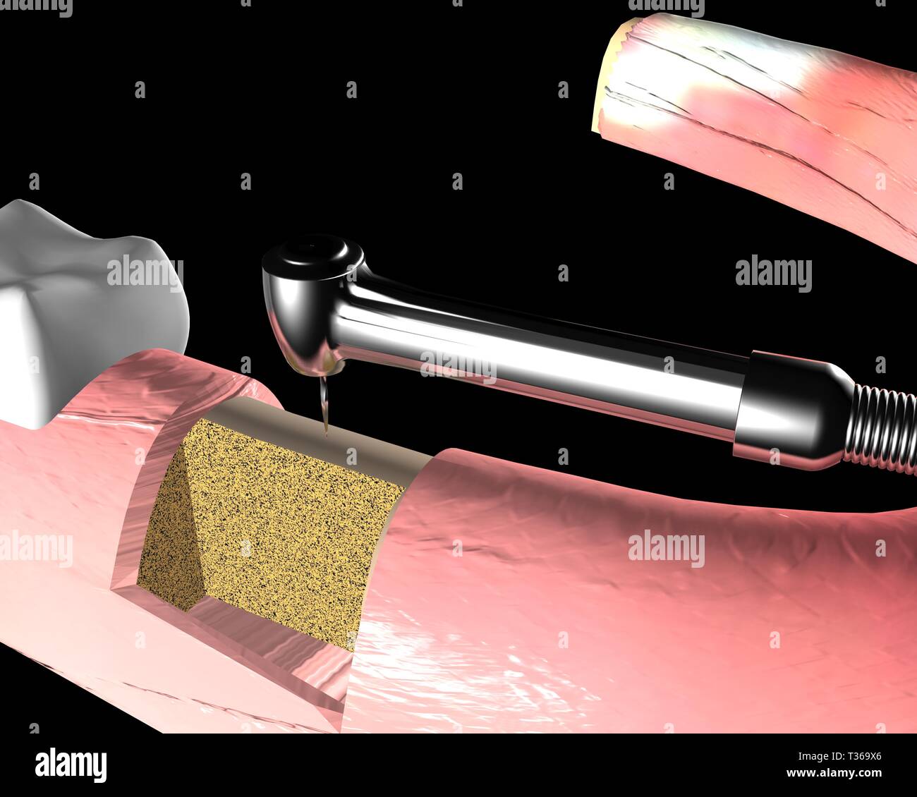 dental implant jaw bone drilling Stock Photo Alamy