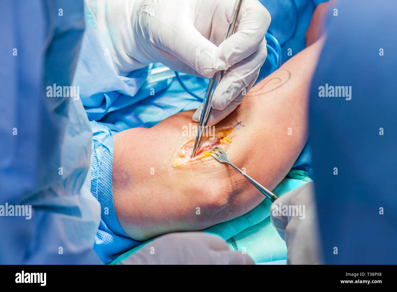 Group of orthopedic surgeons performing surgery on a patient arm Stock Photo