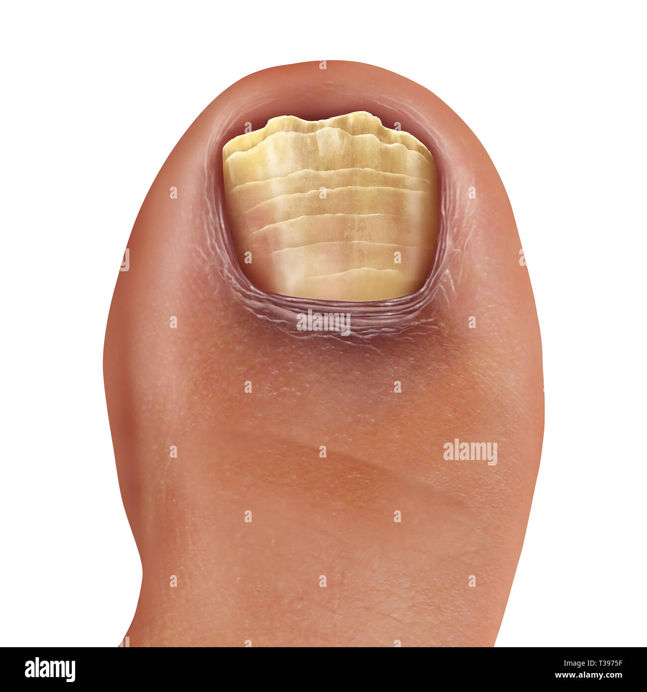 Infected fungal toe nail and feet infection or onychomycosisor tinea unguium as toenail foot disease with damaged unhealthy human anatomy. Stock Photo