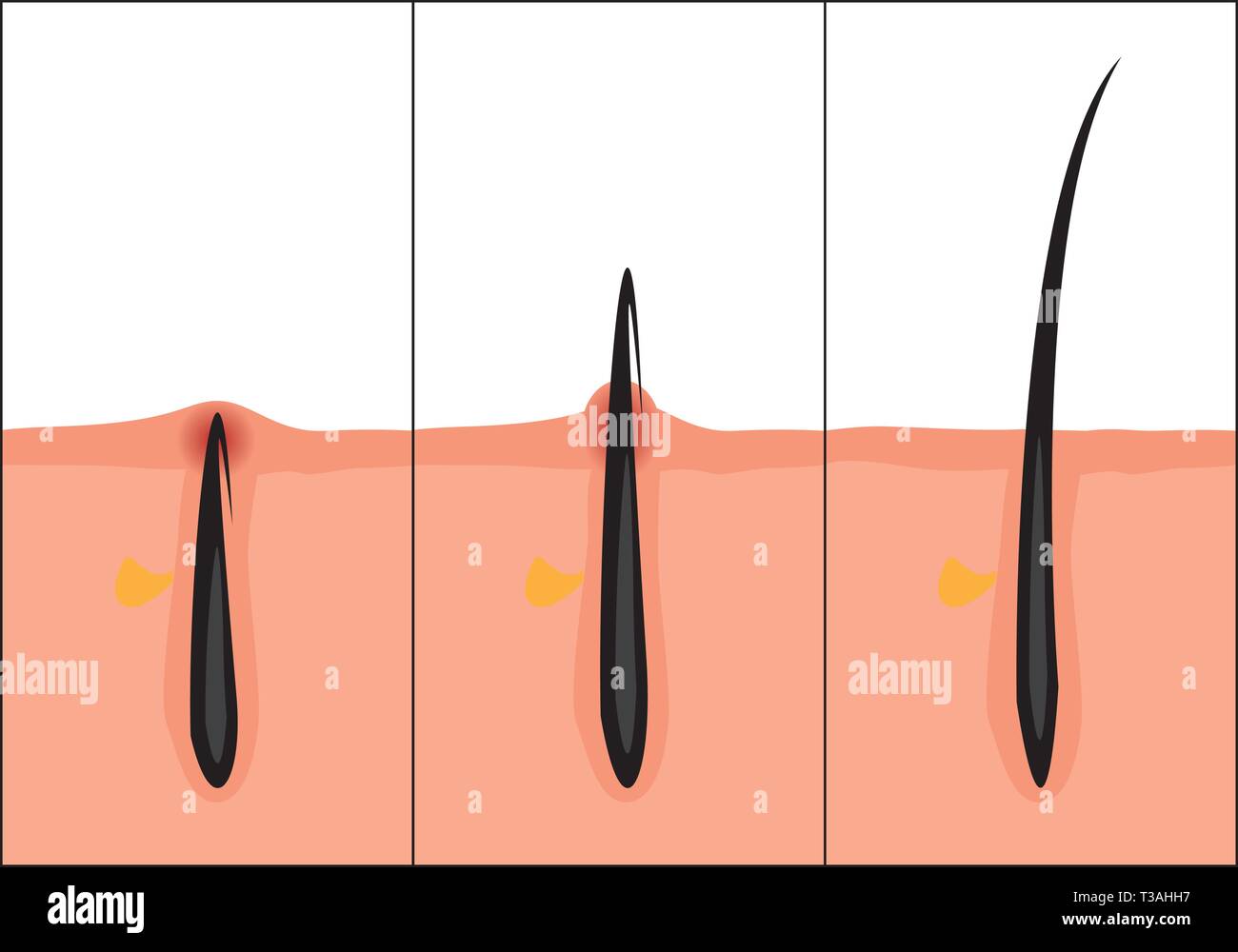 Hair Follicle Infection Stock Photos Hair Follicle Infection