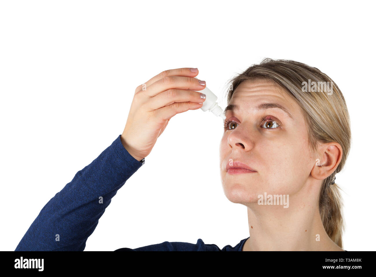 Close up picture of female patient's infected eye. Hordeolum on upper