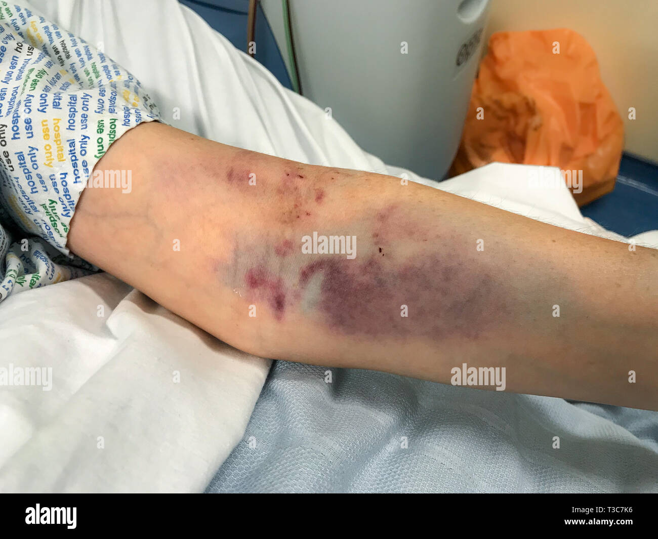 Caucasian womans bruised arm hi-res stock photography and images - Alamy