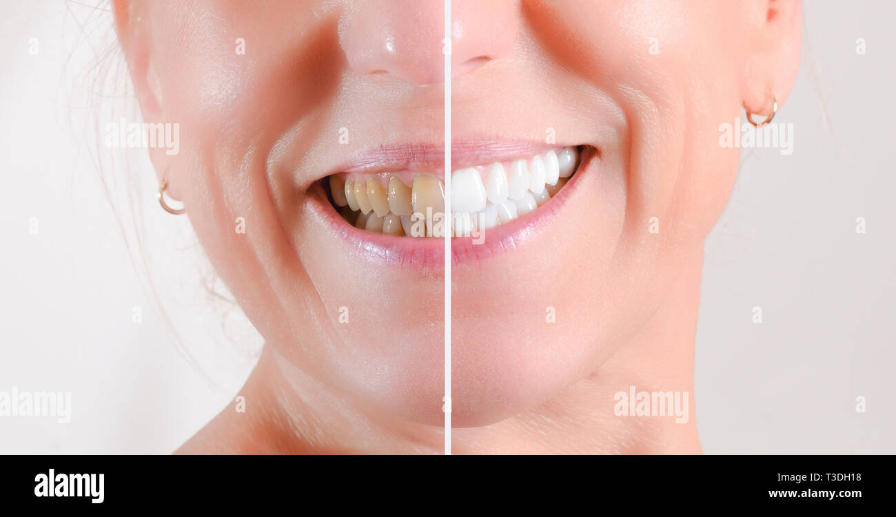 Concept of before and after treatment of cleaning and bleaching teeth on the teeth of a mature woman Stock Photo