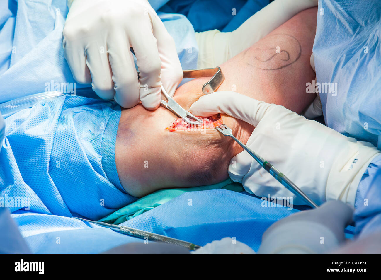 Shoulder Arthroscopy Instability Surgery In Austin Tx