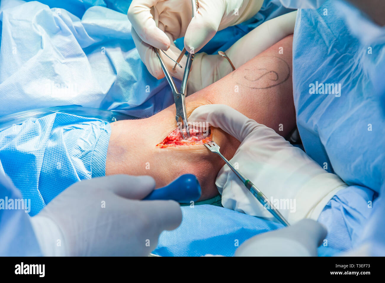 Group of orthopedic surgeons performing surgery on a patient arm Stock Photo