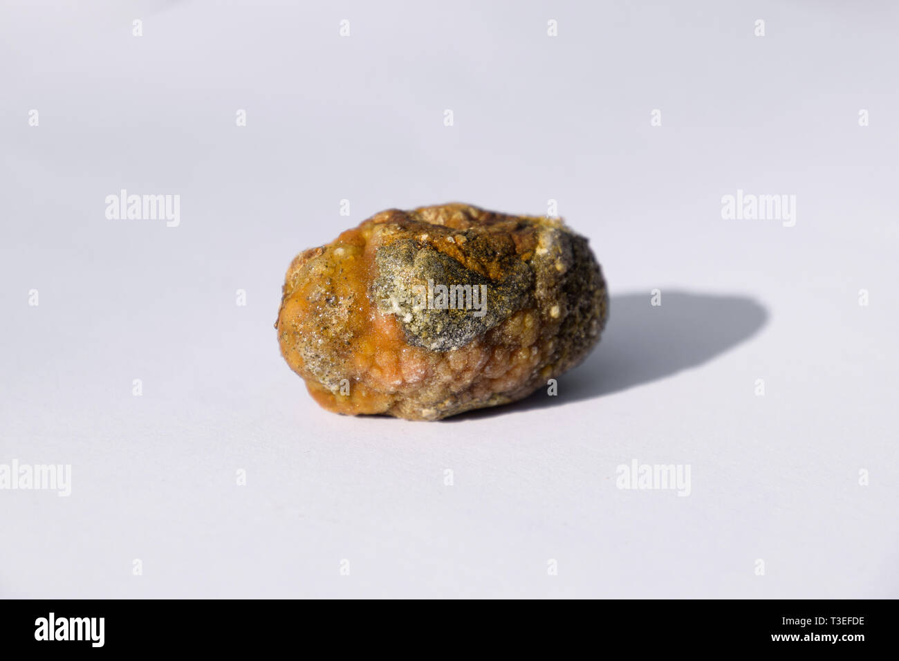 Stone of the gallbladder. The result of gallstones. A calculus of heterogeneous composition. Stock Photo