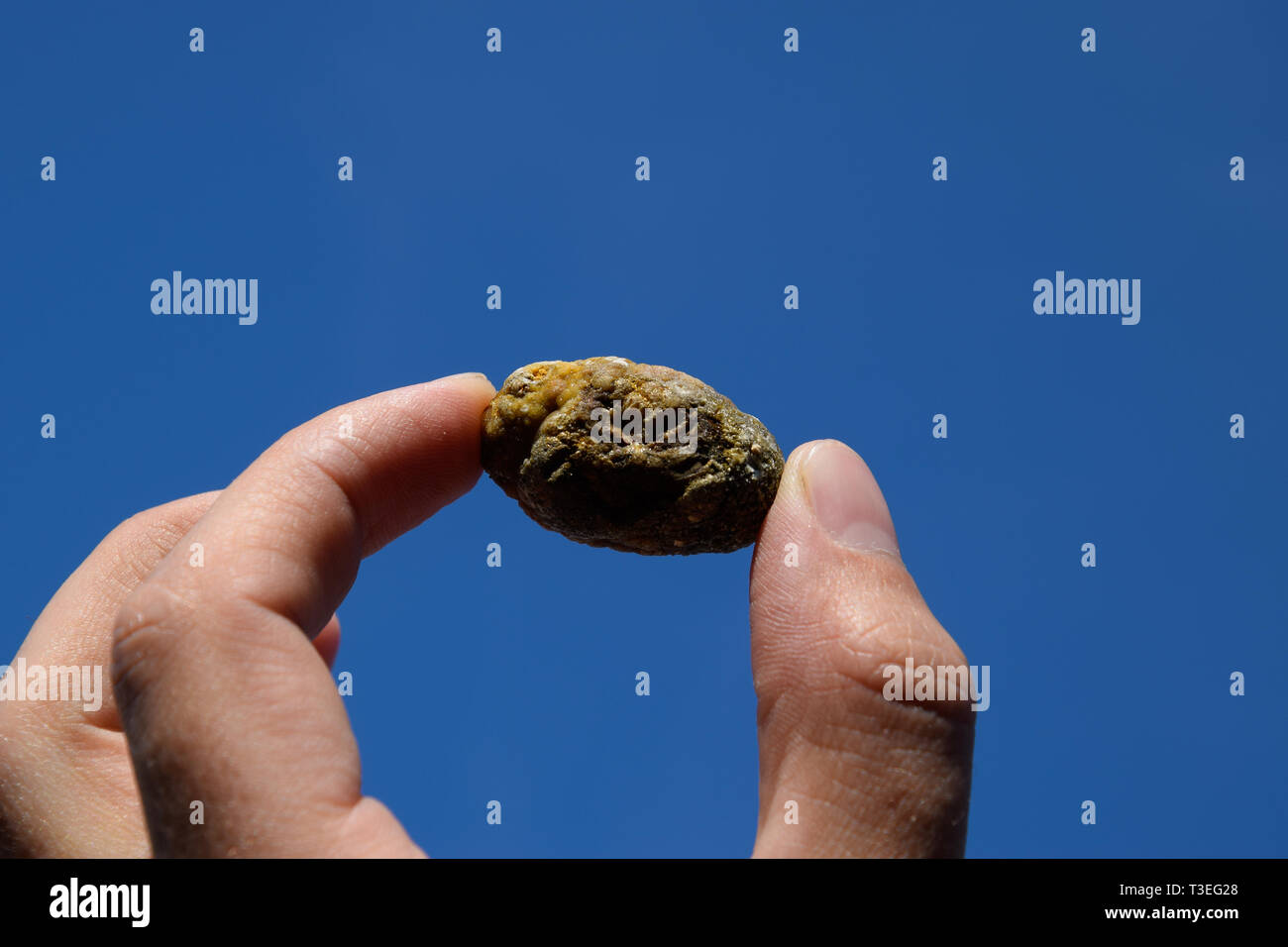 Stone of the gallbladder. The result of gallstones. A calculus of heterogeneous composition against a blue sky. Stock Photo