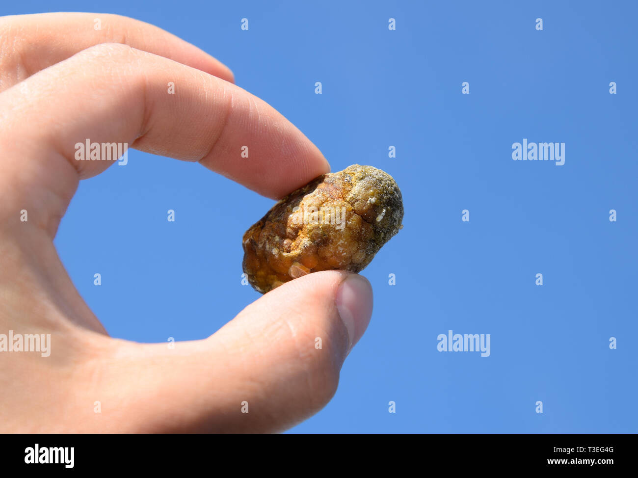 Stone of the gallbladder. The result of gallstones. A calculus of heterogeneous composition against a blue sky. Stock Photo