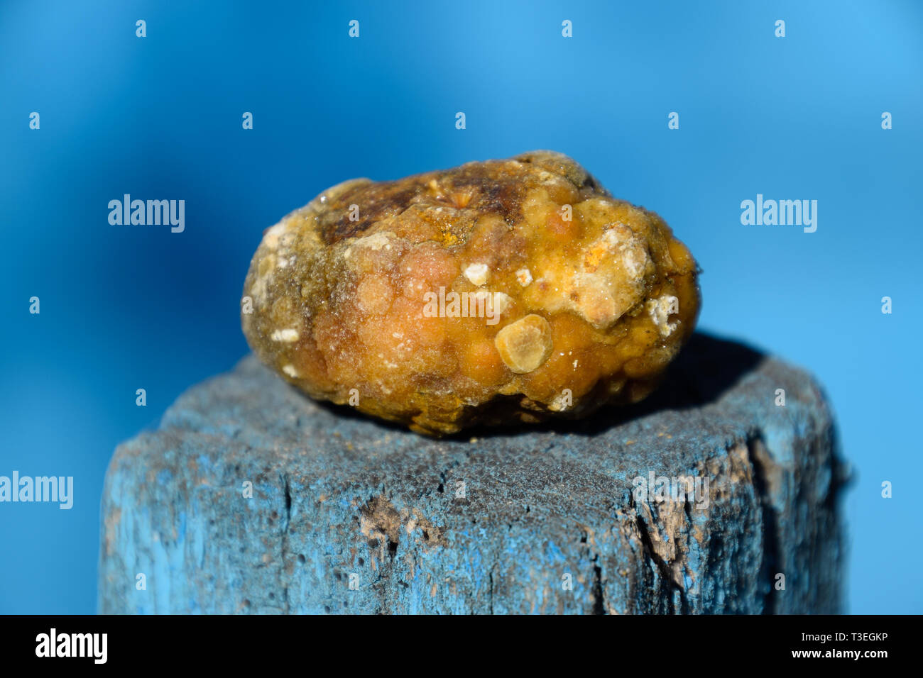 Gall bladder stone. The result of gallstones. Calculus of heterogeneous composition Stock Photo