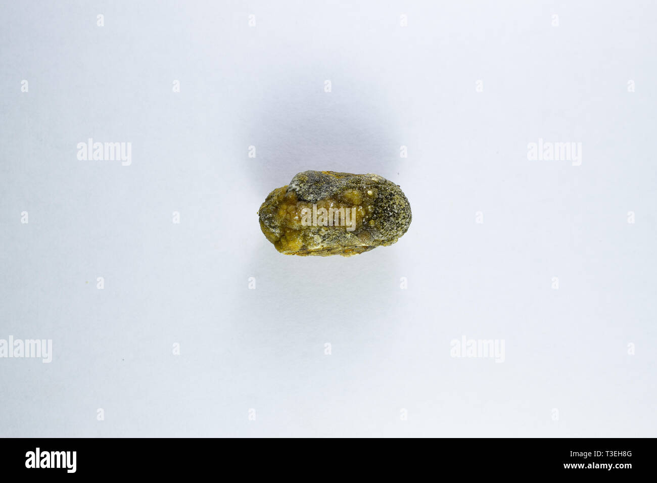 Large gallstone, Gall bladder stone. The result of gallstones. Calculus of heterogeneous composition Stock Photo