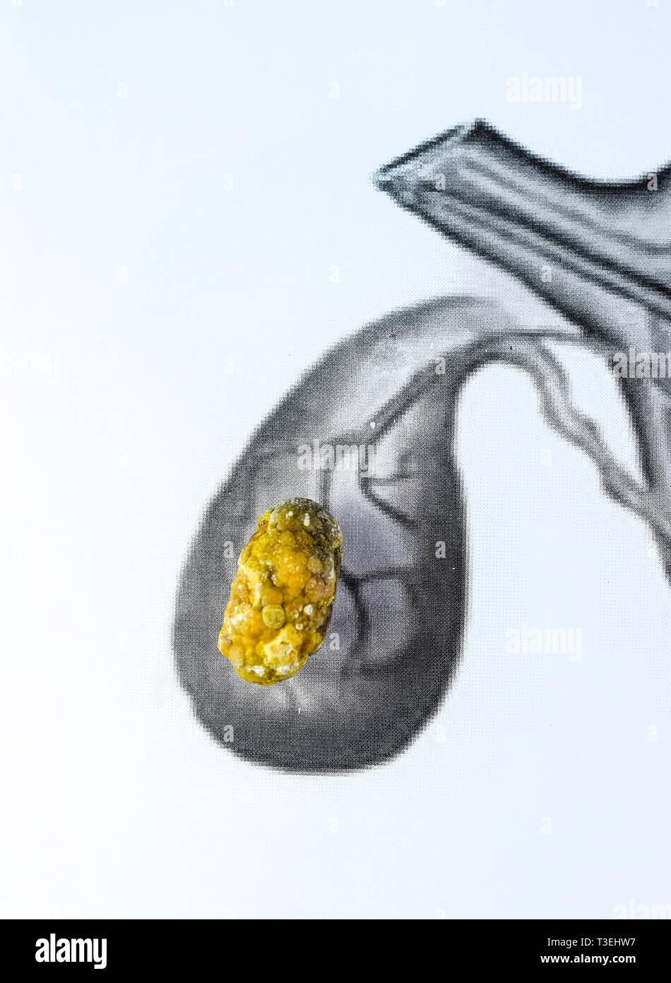 Gall bladder stone, schematic depiction, large-sized Gallstone, Result of gallstone disease. Stock Photo