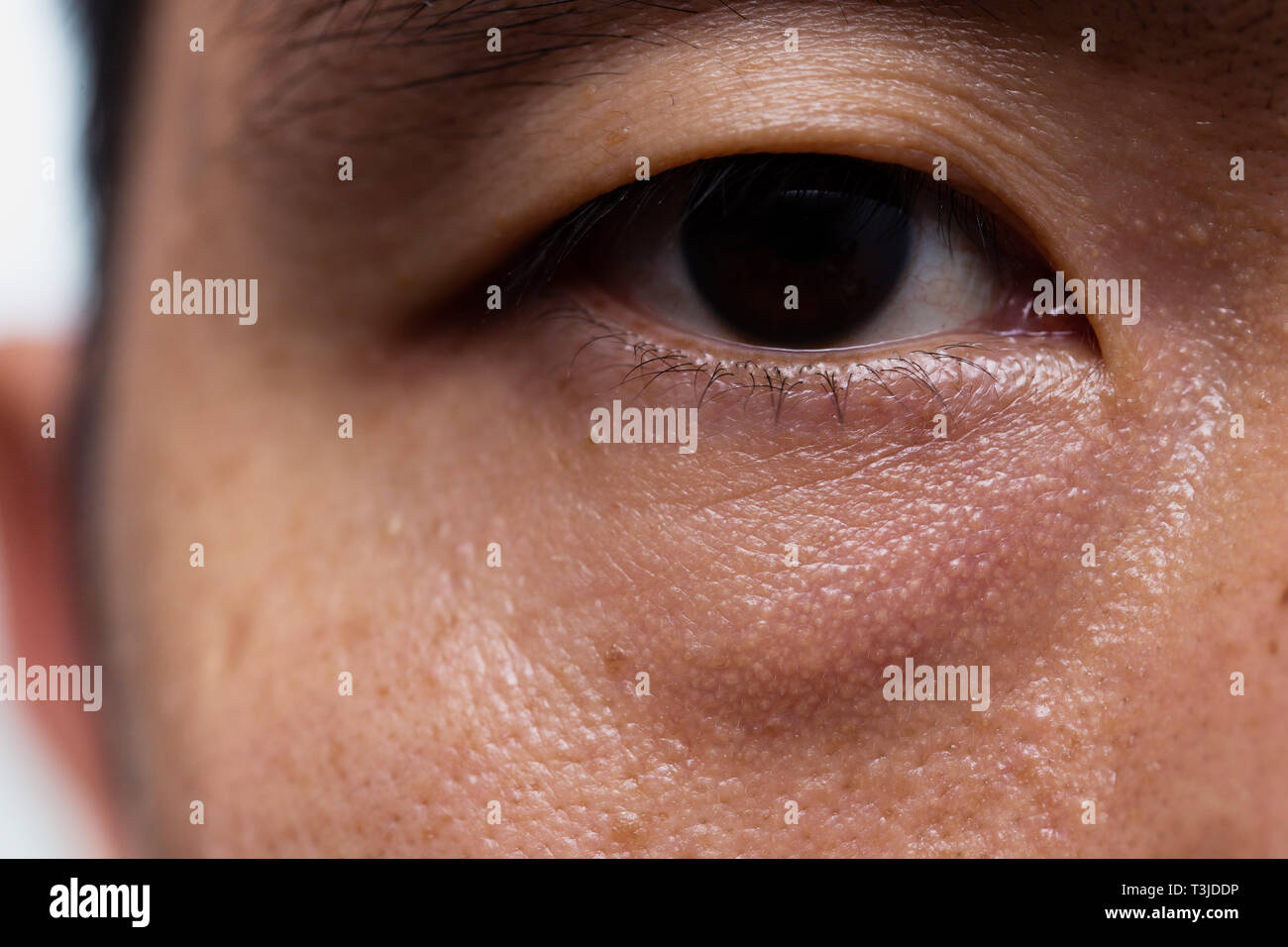 Ptosis (Droopy eyelid) in asian male oily skin type with dark eye bag Stock Photo