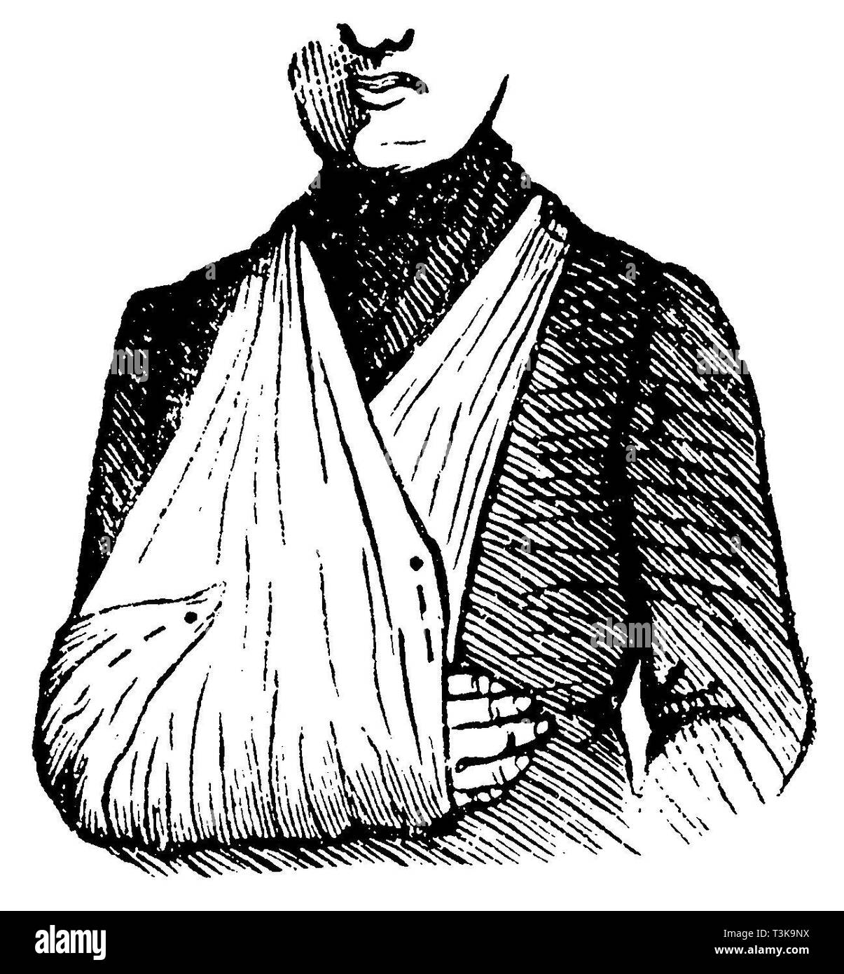 Arm sling, anonym  1887 Stock Photo