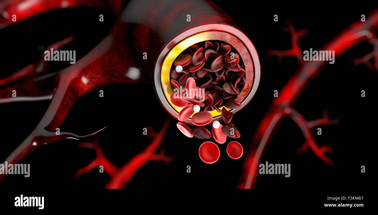 Sickle cell anemia, showing blood vessel with normal and deformated crescent. 3D illustration Stock Photo